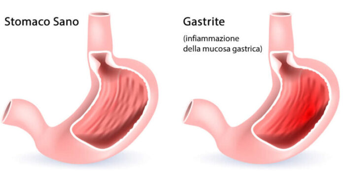 gastrite