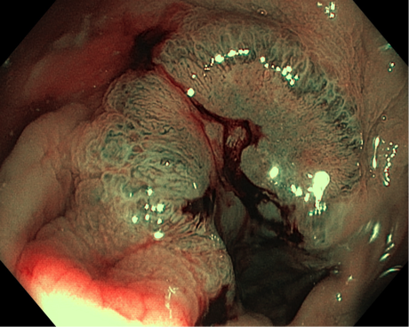 carcinoma colo-rettale - archivio Prof. Tomasello